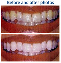 Teeth whitening