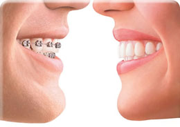 Are Invisalign braces right for you