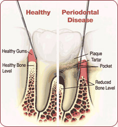 Periodontal tooth disease