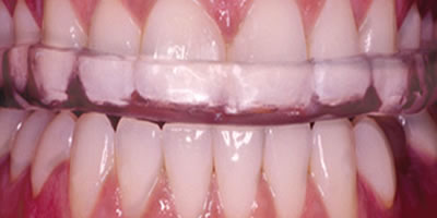 Teeth Grinding Device