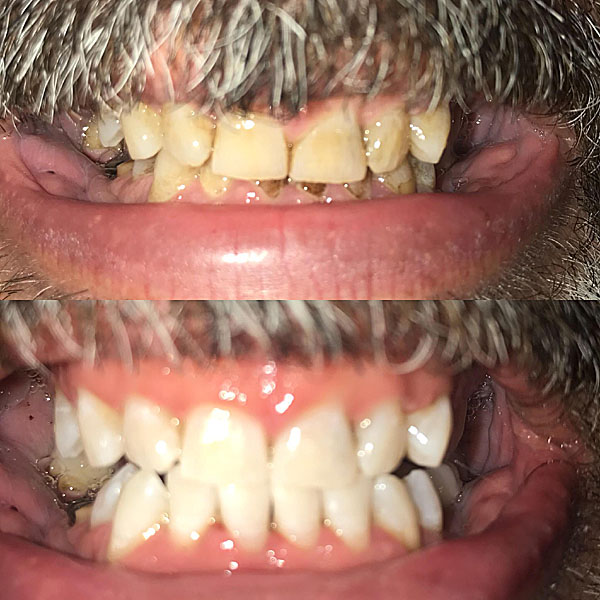Zoom Teeth Whitening Results