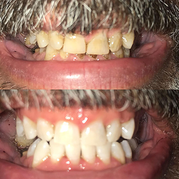 zoom-teeth-whitening-produces-amazing-results-moore-family-dental