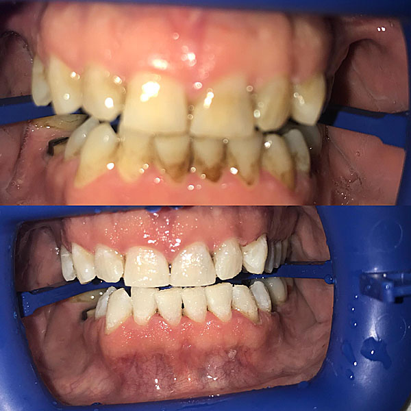 zoom teeth whitening vs laser