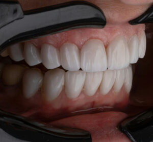 Bleeding gums